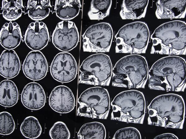 Diagnosticando una Lesión Cerebral Traumática