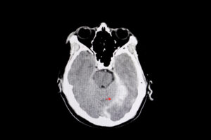 A brain scan image. Learn about the difference between concussion and TBI